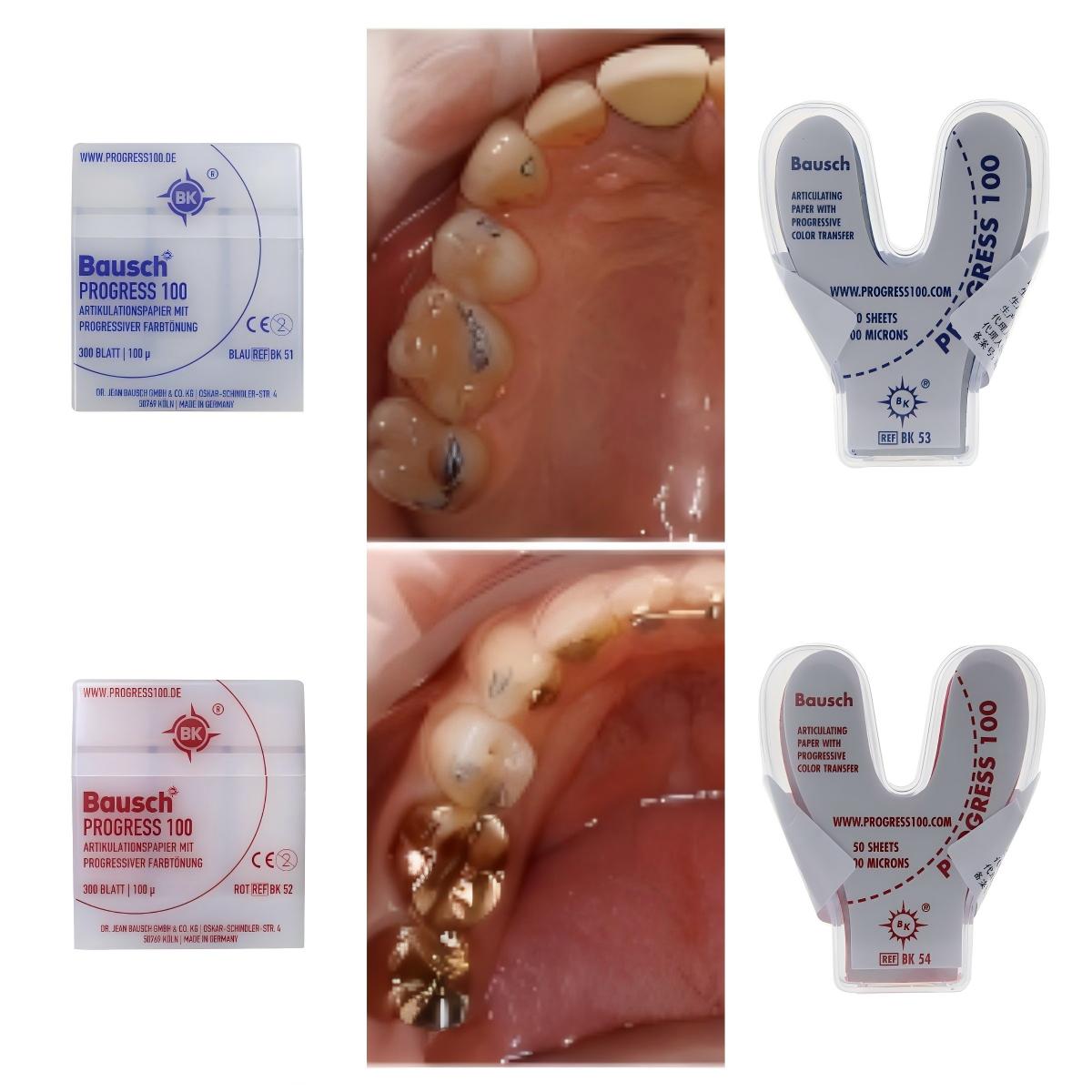 Bausch BK51 BK52 BK53 BK54 Den - Bite Indicator 리뷰 및 가격